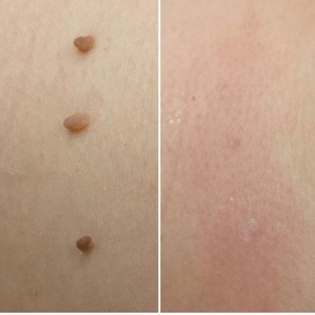 Brivori™ – Elimina acrocordones de forma segura en casa
