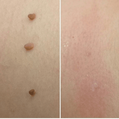 Brivori™ – Elimina acrocordones de forma segura en casa