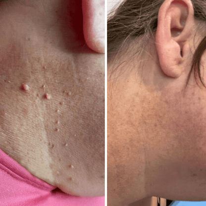 Brivori™ – Elimina acrocordones de forma segura en casa