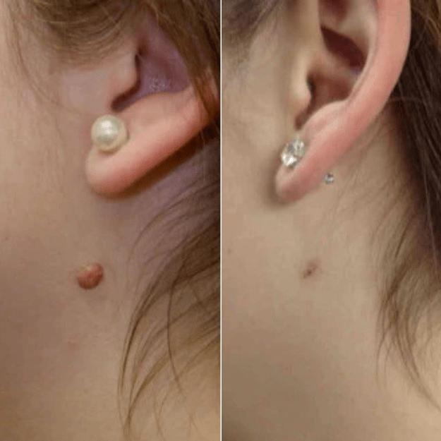 Brivori™ – Elimina acrocordones de forma segura en casa