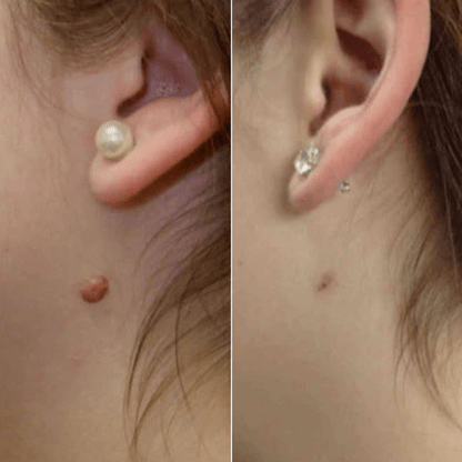 Brivori™ – Elimina acrocordones de forma segura en casa