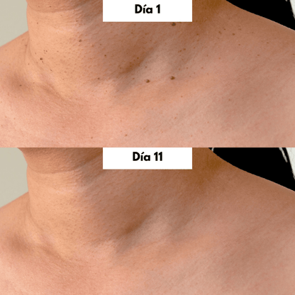 Brivori™ – Elimina acrocordones de forma segura en casa